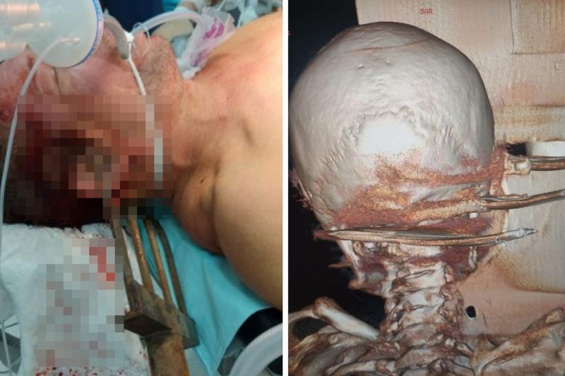 Мужчину, воткнувшего вилы в голову товарища, будут судить в Новосибирске